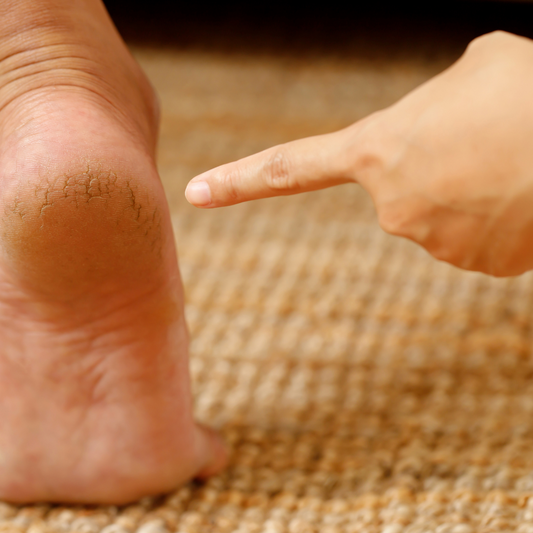 Talons fendillés, pieds secs : la solution à portée de main